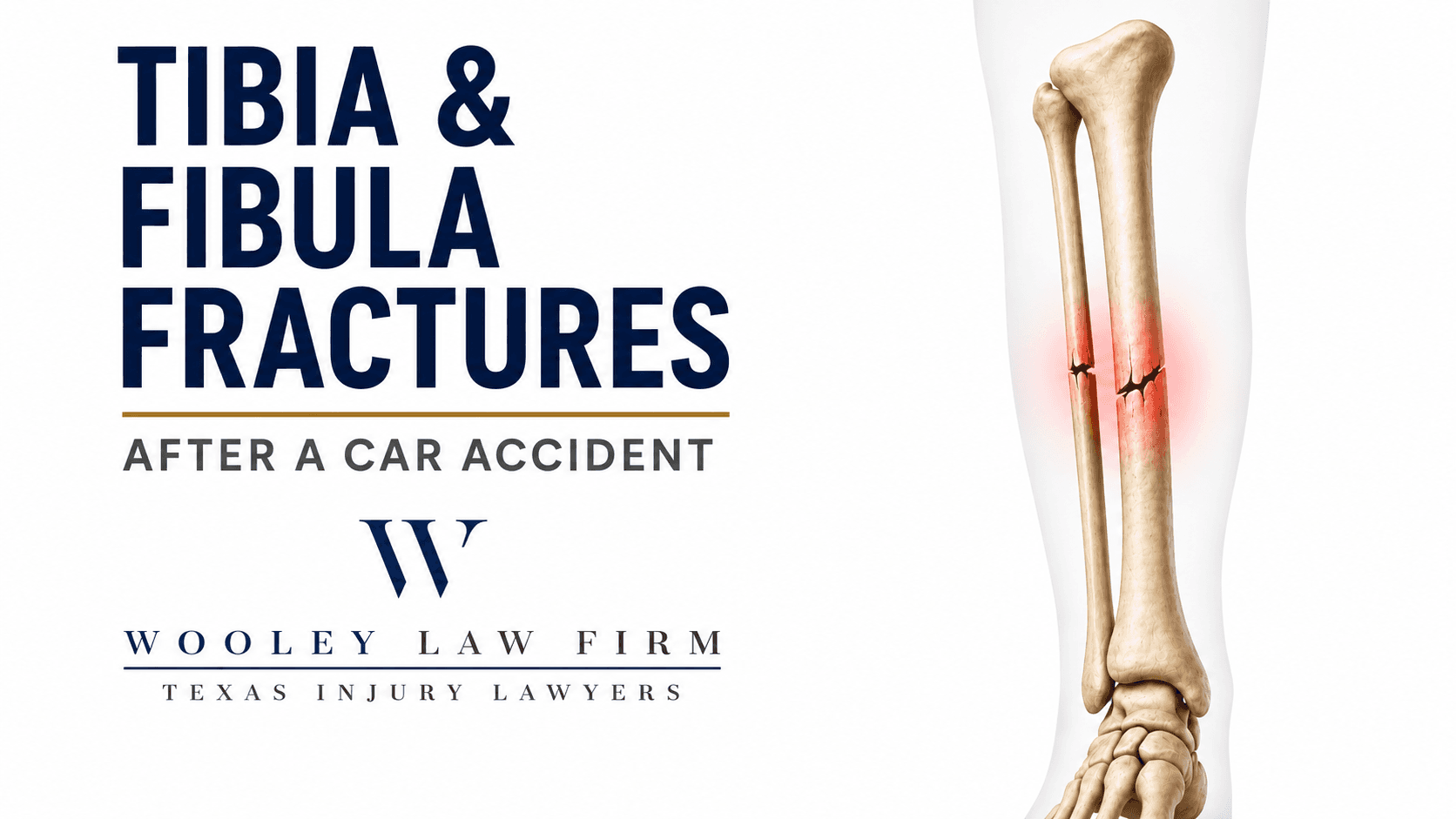 Tibia and Fibula Fractures After a Dallas Car Accident: What Victims Need to Know